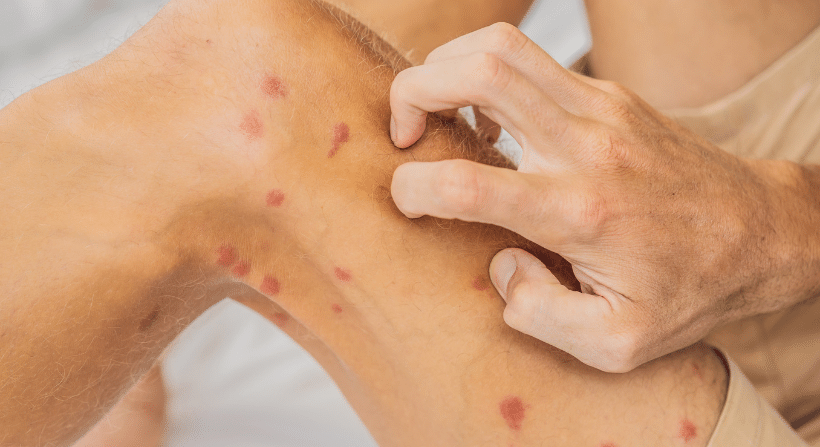 Itchy Bed Bug Bites Allergic reactions