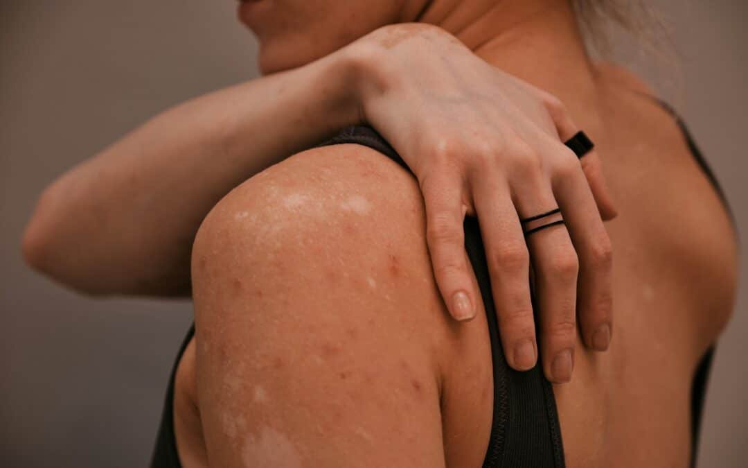 How To Identify Bed Bug Bites And When To Call A Professional In Oklahoma City