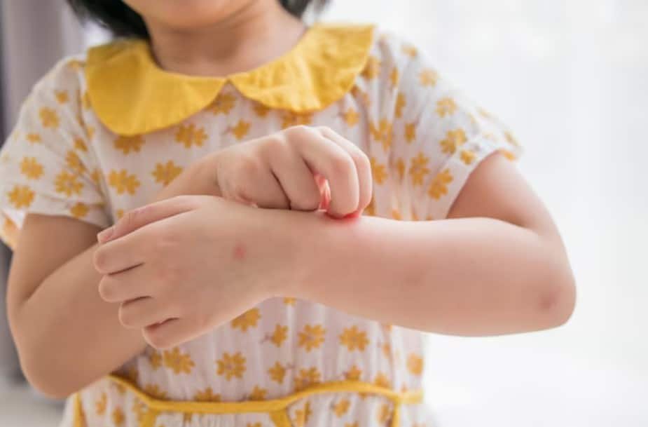 Identifying and Treating Bed Bug Bites in Children